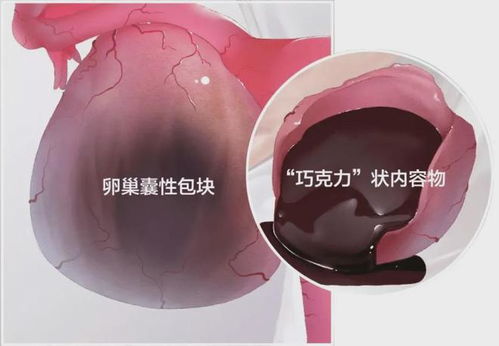25岁女生痛经十几年决定停经(一位25岁女生长达十几年的痛经经历与她的停经决定)